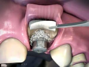 مزایای پودر استخوان و معایب و عوارض احتمالی استفاده از آن