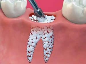مزایای پودر استخوان و معایب و عوارض احتمالی استفاده از آن